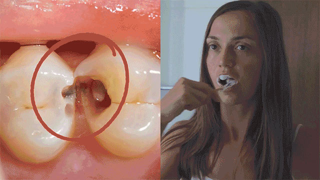 Close-up of tooth decay compared with a woman brushing her teeth daily
